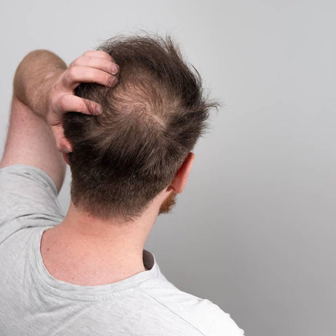 Hair Loss Awareness Month